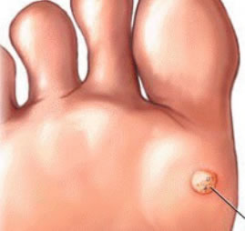 Verruga Plantar